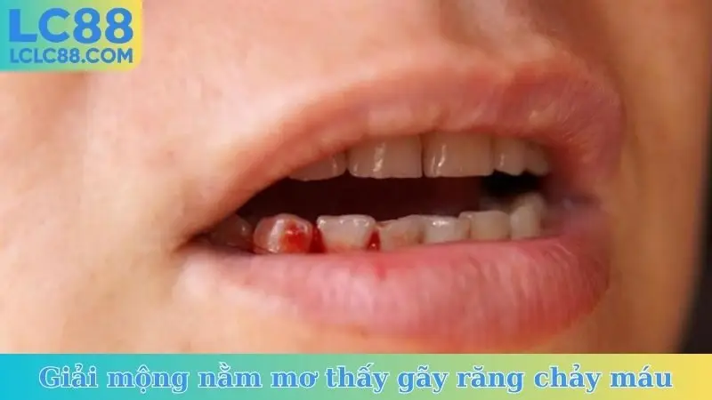 Giải mộng nằm mơ thấy gãy răng chảy máu